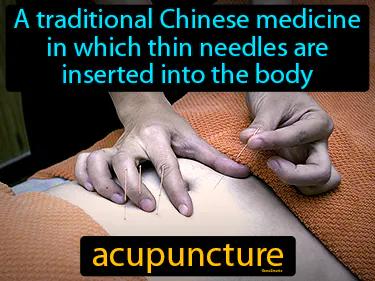 acupuncture Simple Definition