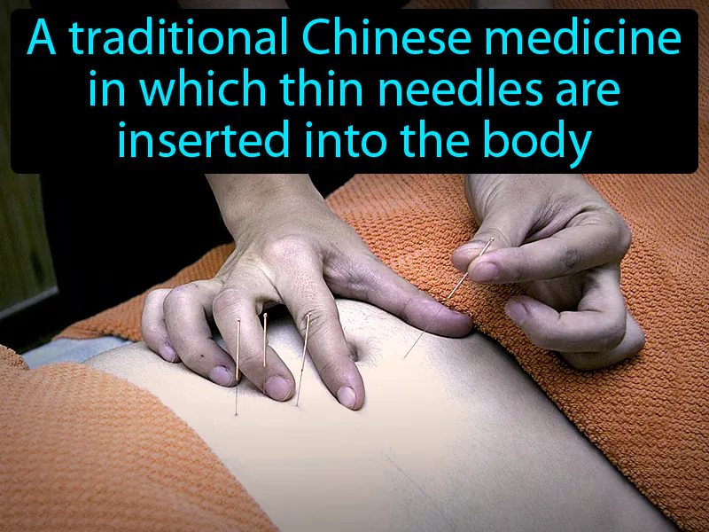 Acupuncture Definition